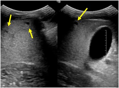 Diagnosis and Management of Hepatobiliary Complications in Autosomal Recessive Polycystic Kidney Disease